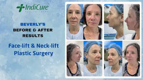 Beverly face and Neck Lift Before and After Pictures Beverly face and Neck Lift Before and After Pictures